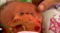İki yüzlü doğan bebek yaşam mücadelesi veriyor